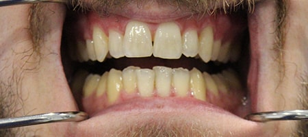 Before and After Invisalign Treatment Milton Keynes Before and After Invisalign Treatment Milton Keynes