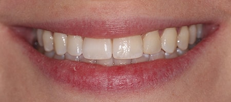 Before and After Invisalign Treatment Milton Keynes Before and After Invisalign Treatment Milton Keynes