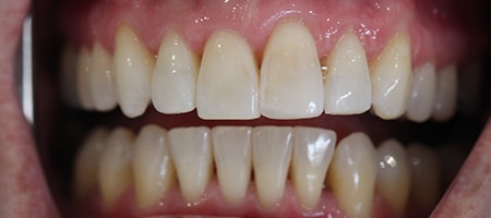 Before and After Invisalign Treatment Milton Keynes Before and After Invisalign Treatment Milton Keynes