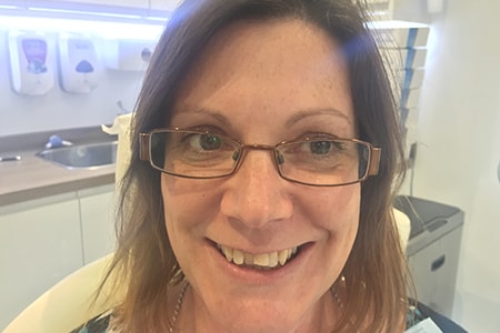 Before and After Invisalign Treatment Milton Keynes Before and After Invisalign Treatment Milton Keynes