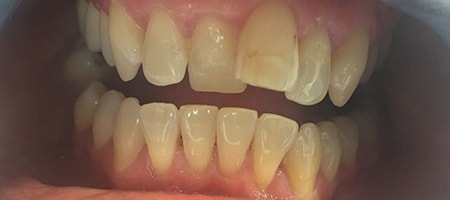 Before and After Invisalign Treatment Milton Keynes Before and After Invisalign Treatment Milton Keynes