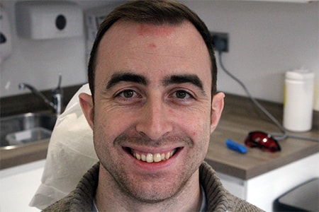 Before and After Invisalign Treatment Milton Keynes Before and After Invisalign Treatment Milton Keynes