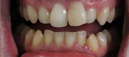 Before and After Invisalign Treatment Milton Keynes Before and After Invisalign Treatment Milton Keynes