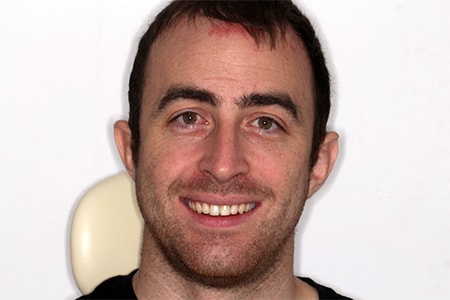 Before and After Invisalign Treatment Milton Keynes Before and After Invisalign Treatment Milton Keynes