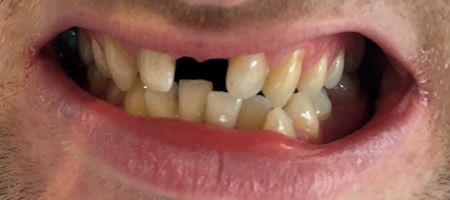 Before and After Invisalign Treatment Milton Keynes Before and After Invisalign Treatment Milton Keynes