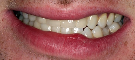 Before and After Invisalign Treatment Milton Keynes Before and After Invisalign Treatment Milton Keynes