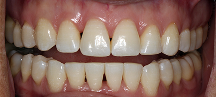 Before and After Invisalign Treatment Milton Keynes Before and After Invisalign Treatment Milton Keynes