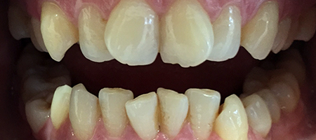 Before and After Invisalign Treatment Milton Keynes Before and After Invisalign Treatment Milton Keynes