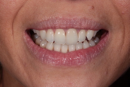 Before and After Invisalign Treatment Milton Keynes