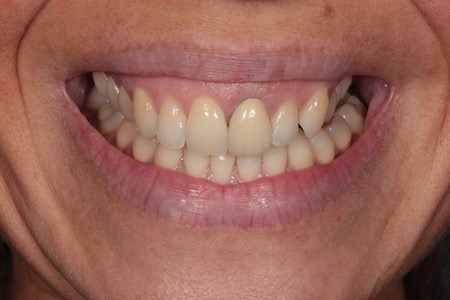 Before and After Invisalign Treatment Milton Keynes
