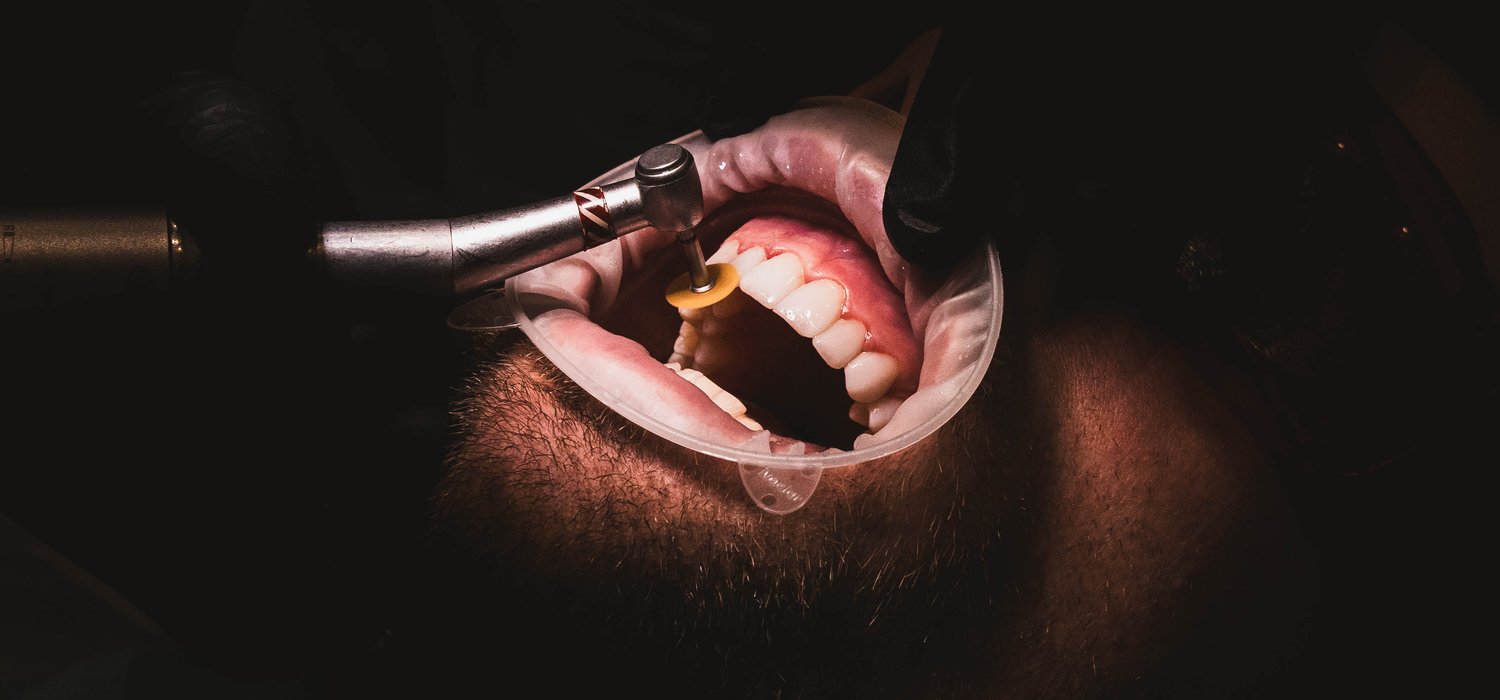 Teeth Straightening