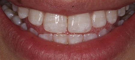 Before and After Invisalign Treatment Milton Keynes Before and After Invisalign Treatment Milton Keynes