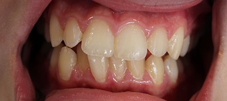 Before and After Invisalign Treatment Milton Keynes Before and After Invisalign Treatment Milton Keynes