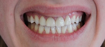 Before and After Invisalign Treatment Milton Keynes
