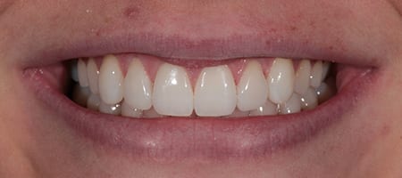 After Invisalign Treatment Reading Smiles