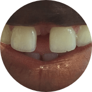 Gaps between teeth