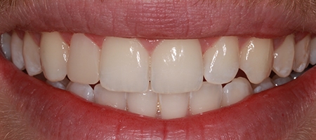 After Invisalign Treatment Reading Smiles 