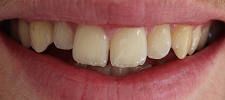 Before Invisalign Treatment at Smile rooms In Milton Keynes