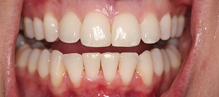 After Invisalign Treatment Reading Smiles 