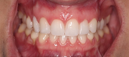 After Invisalign Treatment Reading Smiles 